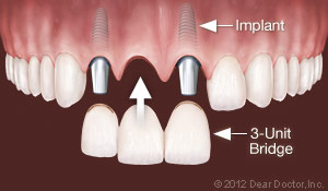 Replacing Multiple Teeth