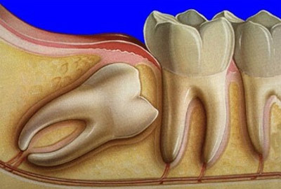 Surgical Extractions