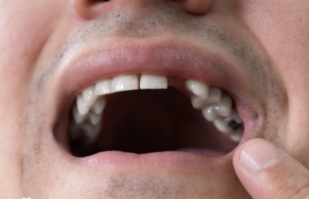 Advanced Dental Implants Offer Long-Term Solution for Missing Teeth at Carolina Dental Specialty Center