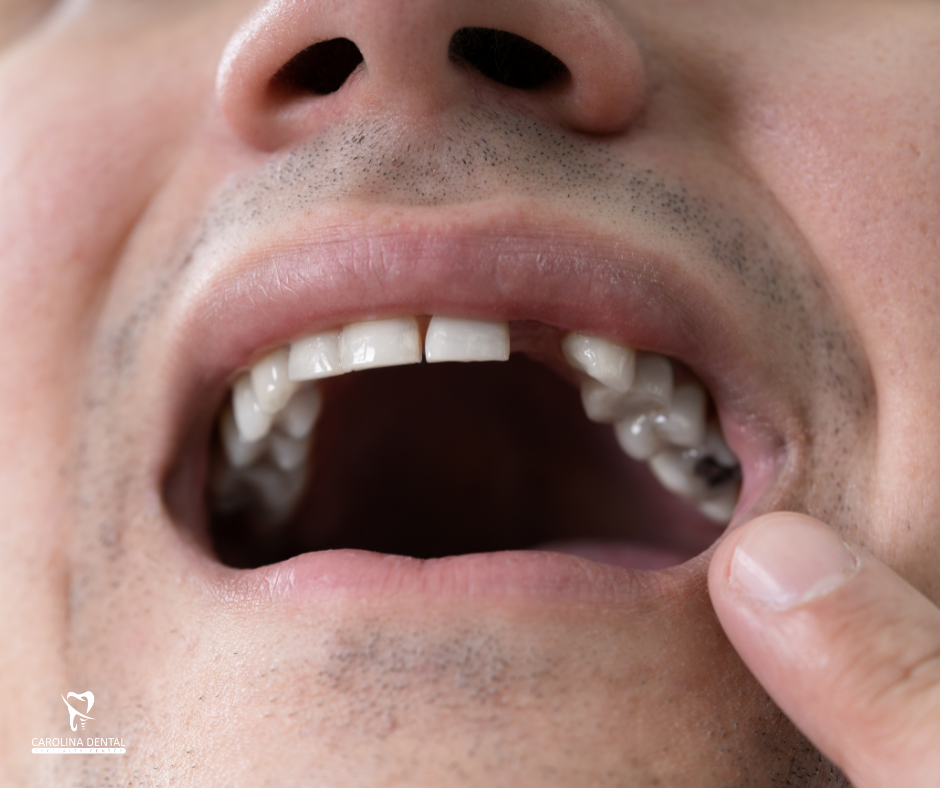 Advanced Dental Implants Offer Long-Term Solution for Missing Teeth at Carolina Dental Specialty Center